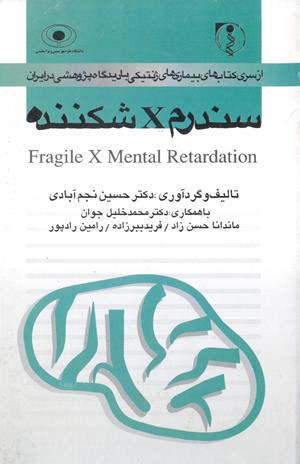 سندرم x شکننده